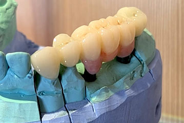 Crowns & Bridges | EV Dental, PC - Englewood, NJ