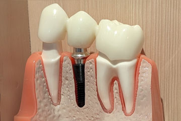Dental Implants | EV Dental, PC - Englewood, NJ